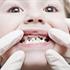 علائم پوسیدگی دندان کودکان و اطفال و روش‌های جلوگیری از آن